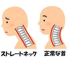 スマホ首必見！ストレートネックの解消法を教えます 多くの人を悩ませるストレートネックの解消を法を教えます イメージ1