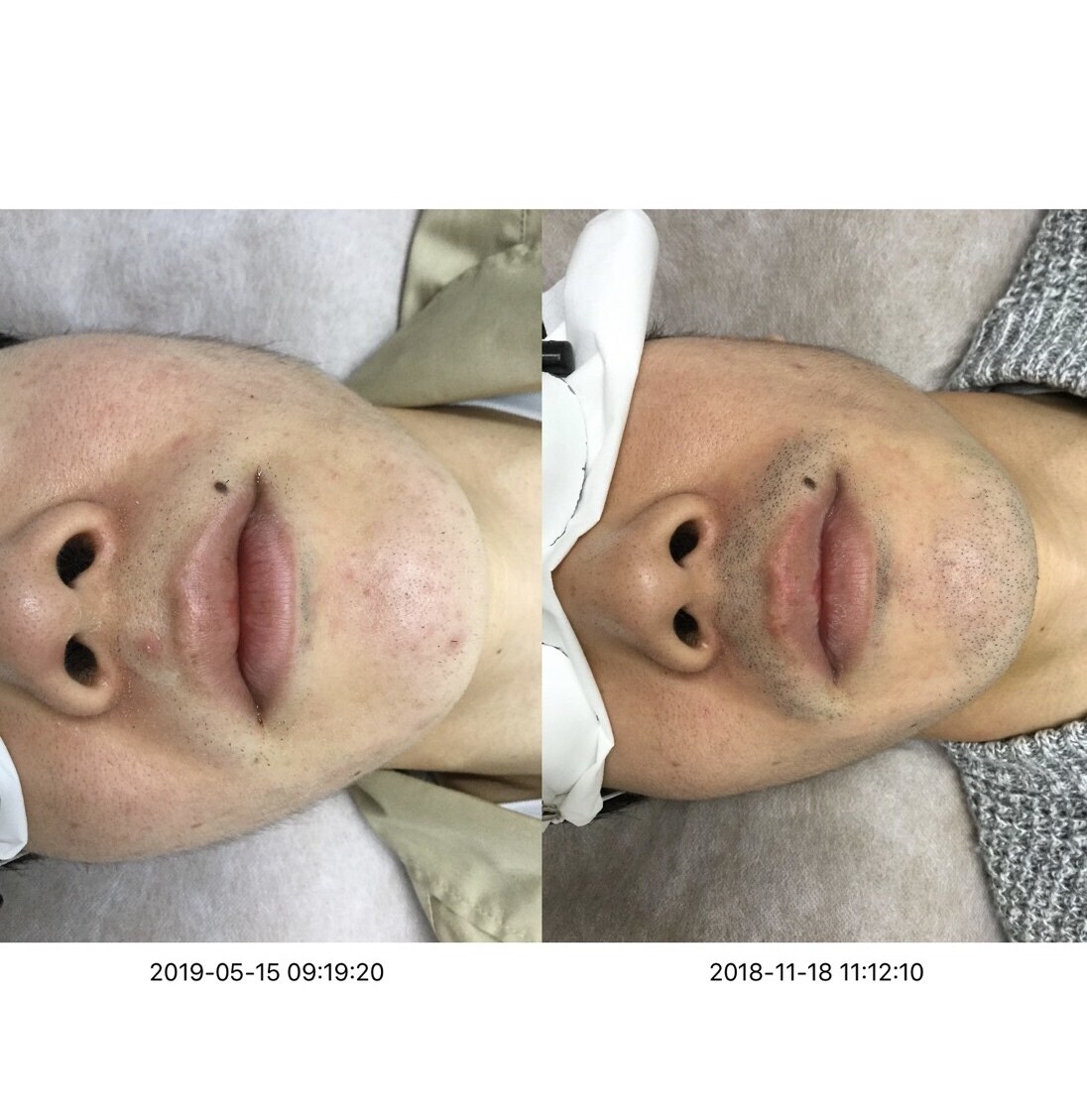 脱毛体験を話します 脱毛に通おうか迷っている人の参考になれば嬉しいです。 イメージ1
