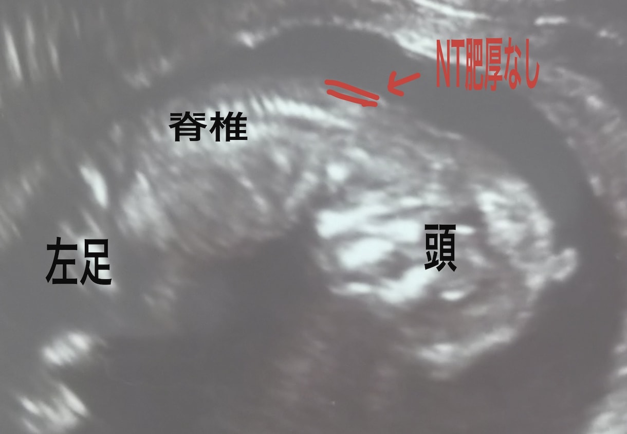 専門医がエコー全体を画像付きで解説します これはなにを見ているのかなど、胎児エコーを詳しく解説。 イメージ2
