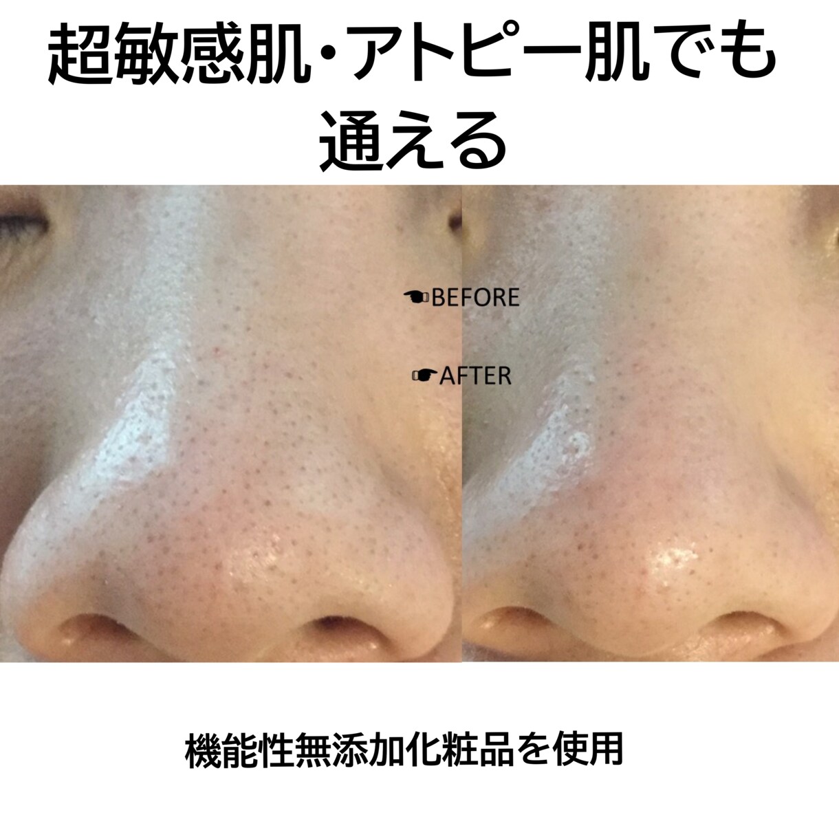 超敏感肌・アトピー肌のホームケをお教え致します ひとりひとりの生活に合わせたホームケアとスキンケアをご紹介 イメージ5