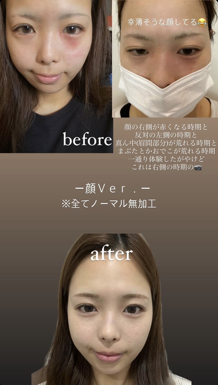 アトピーのお悩み聞きます 元15年アトピーだったアトピーカウンセラーがお話聞きます イメージ3