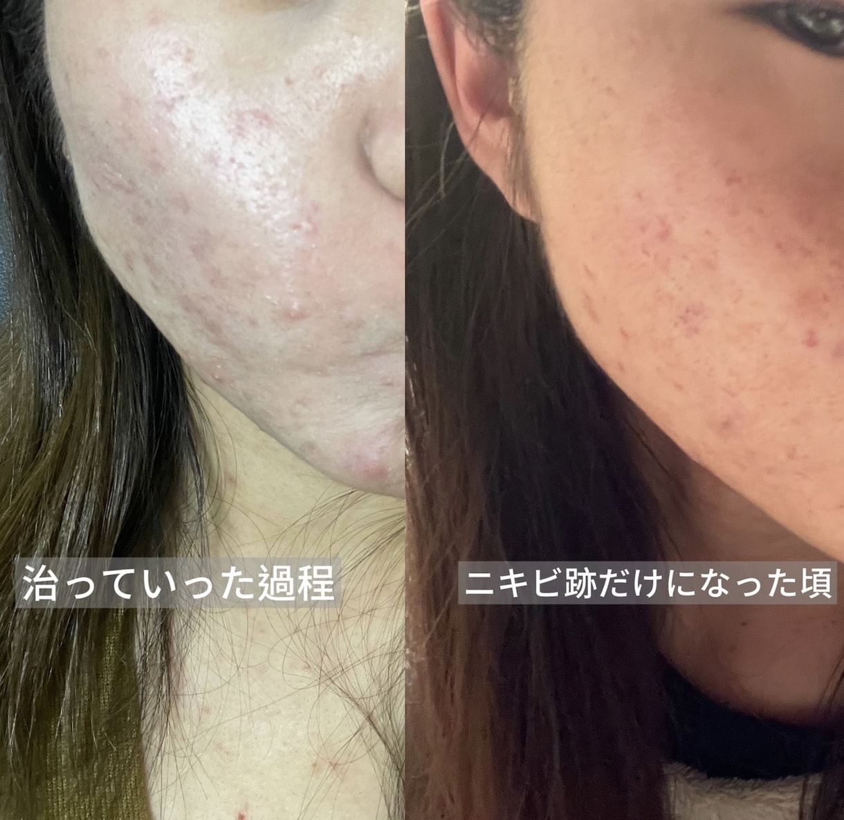 皮膚科で治らないニキビを改善した方法をお伝えします 生活習慣を見直して、ニキビができにくい肌を目指しませんか？ イメージ2