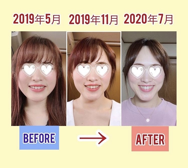 オンライン結婚式【小顔画面映えする】小顔を作ります メスを入れず自宅で整形級レベルの小顔を作る！ イメージ2