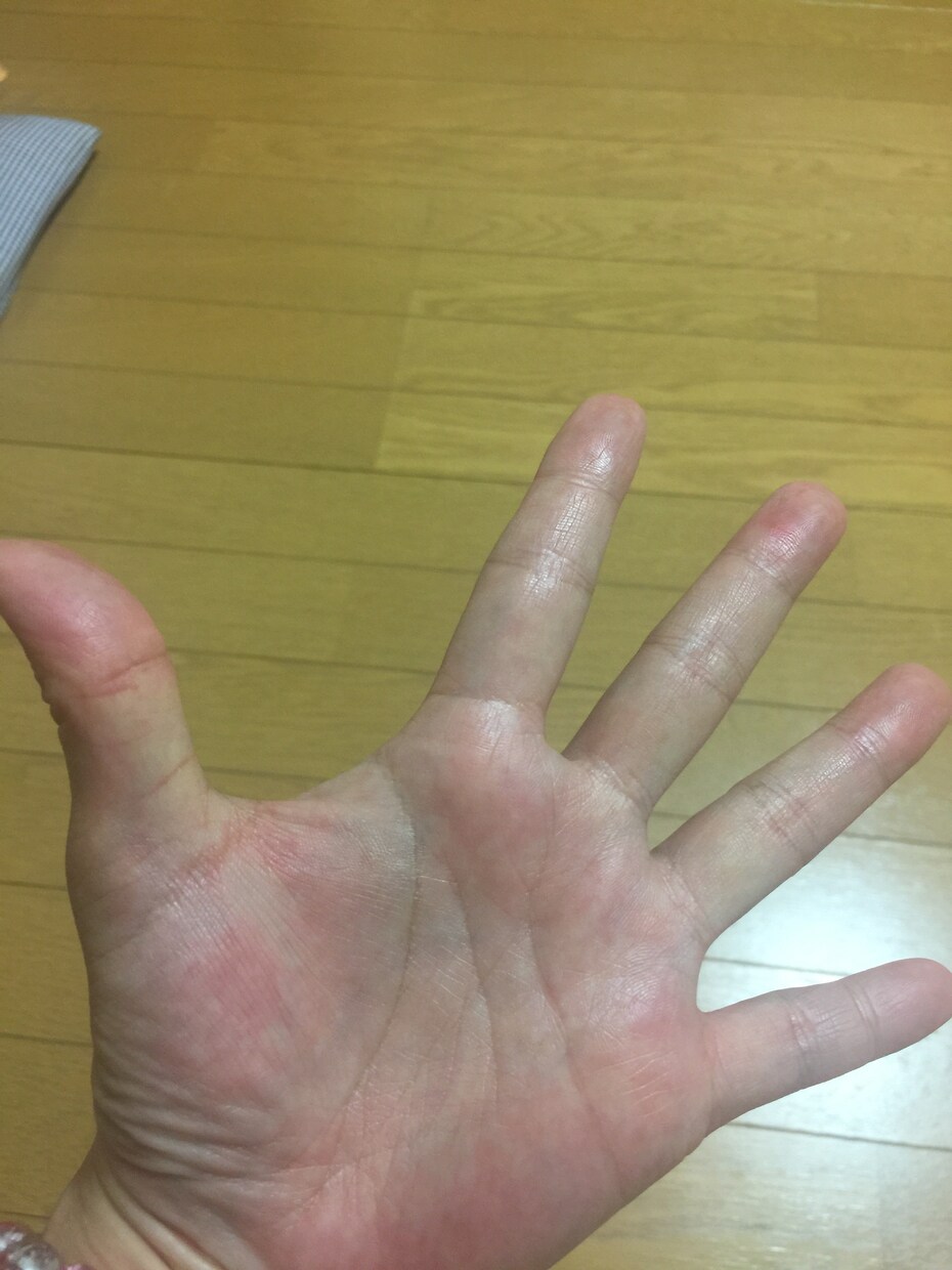 手荒れは治ります 手荒れを克服した体験談&商品を 手荒れで悩んでいる方に☆ イメージ1