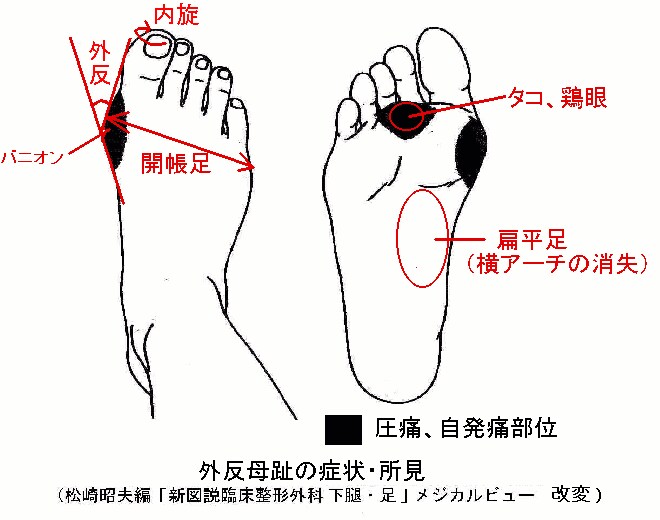 正しいスポーツシューズの選び方教えます 足やひざの痛みで大好きなスポーツが楽しめない貴方にオススメ。 イメージ3