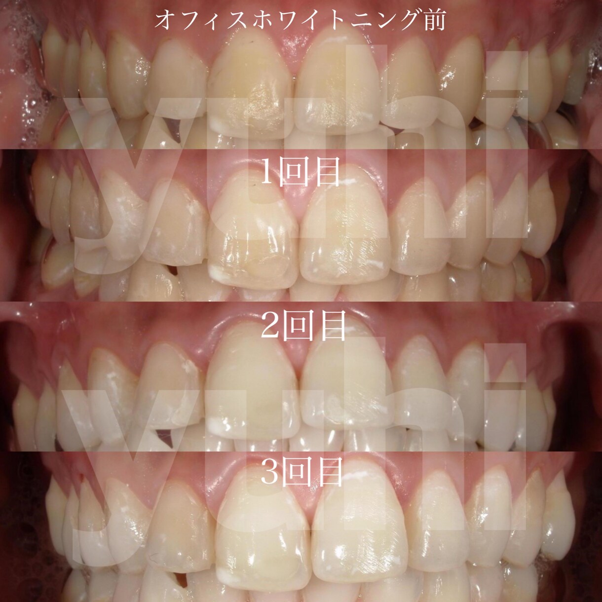 ホワイトニングの説明をします 種類があります！自分にピッタリな適切なホワイトニングを選択 イメージ3