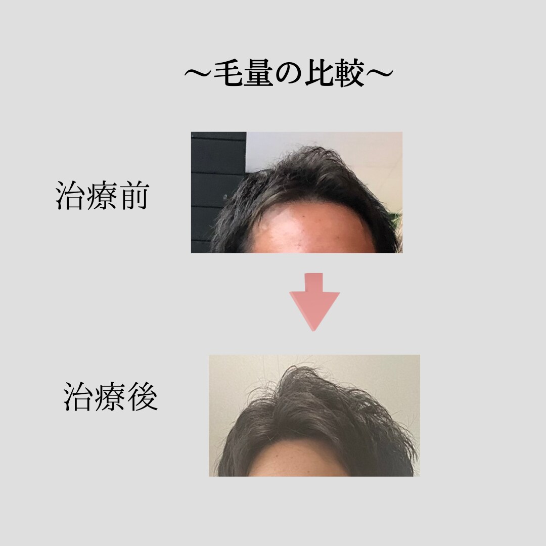 薄毛に悩む方に！薄毛対策教えます 〜思ってたよりも安く薄毛対策出来ます〜 イメージ3