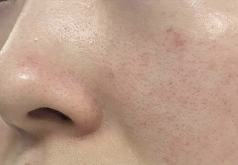 顔写真の肌荒れや肌色を直します あなた用のお好きな肌加工をします イメージ1