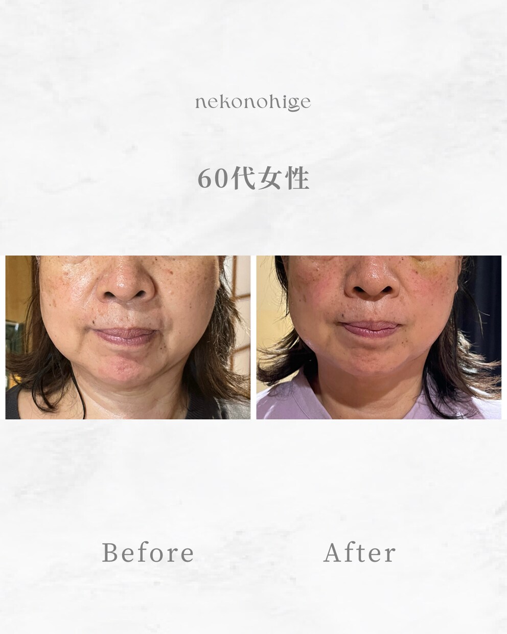 顔に鍼を打ってるだけ”から卒業できます お客様に変化を実感させる美容鍼の基礎からの打ち方 イメージ3