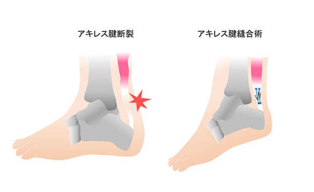 アキレス腱を断裂した方の不安解消します 断裂したばかりで不安いっぱいの方、話聞きます。 イメージ1