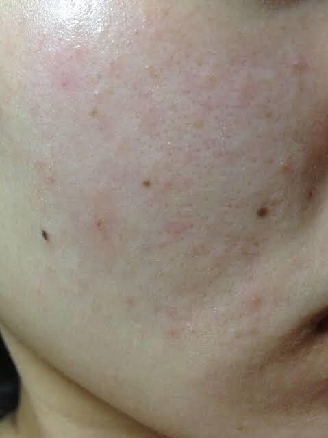 肌のお悩みの相談乗ります 肌荒れ、乾燥肌、毛穴がきになる方へ イメージ3
