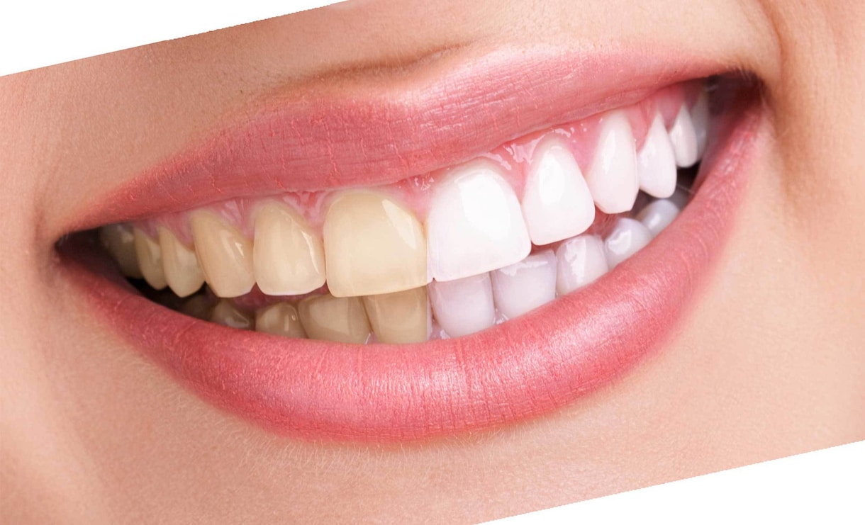歯を白くする画像加工をします 自然な白い歯にします！印象アップに！ イメージ1