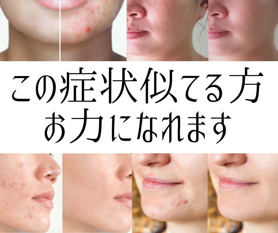 無料相談あり！肌を丈夫に美しくする方法教えます ココナラ初出品記念！美容の先生が肌トラブル改善いたします！ イメージ3