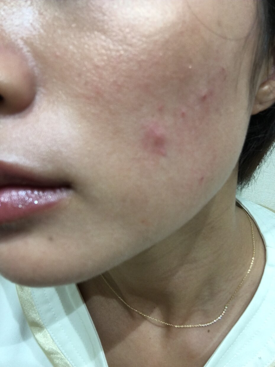 お肌のお悩み、コンプレックスお聞きします 止まらないニキビにお悩みの方、素肌をきれいにしたい方 イメージ1