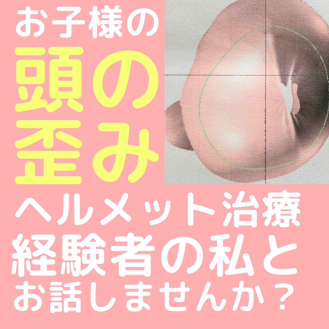 お子様の頭の歪み、ヘルメット治療経験者がお話します お子様の斜頭症、短頭症などでお悩みの方へ。 イメージ1