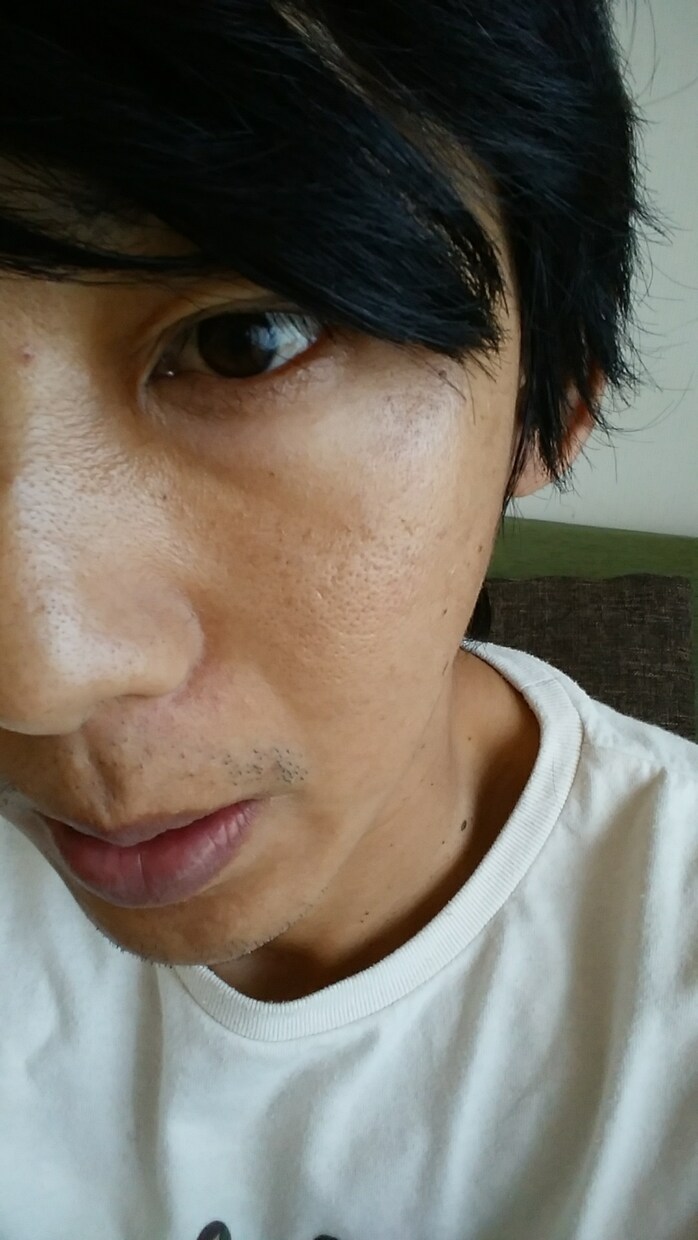 ニキビに悩む皆様にアドバイスします 若いときニキビに悩んだ経験を今悩んでる彼方にアドバイスします イメージ2