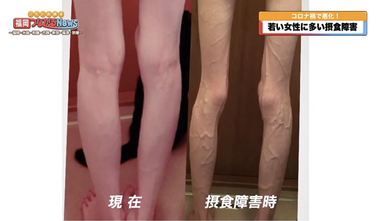 摂食障害の悩みを乗り越えられるよう寄り添います 163cm25kgを克服してCAになった相談員がサポート イメージ2