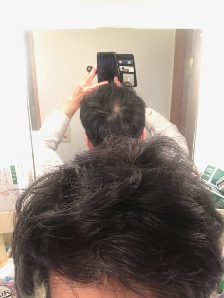 AGA薄毛「月2000円以上」の方 必見となります 40歳重度のAGA薄毛だった私がコスパ最高で帽子不要になった イメージ2