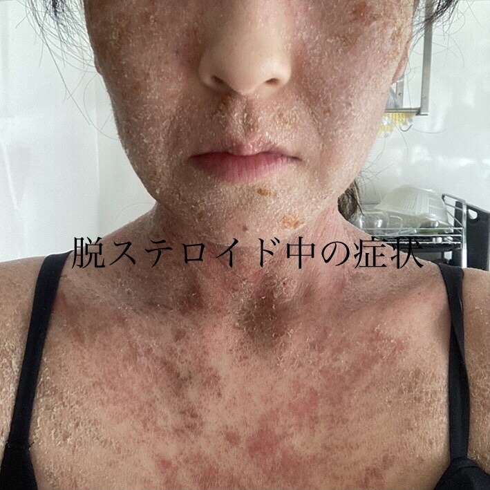 誰にも話せないアトピーの悩み聞きます経験談話します 20年間アトピーに悩み脱ステロイドを経験し、改善したOLです イメージ2