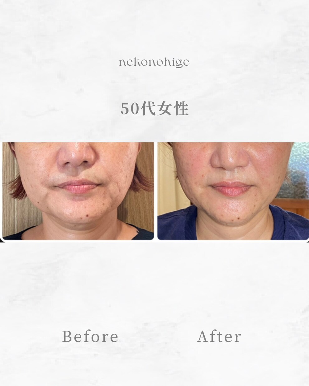 顔に鍼を打ってるだけ”から卒業できます お客様に変化を実感させる美容鍼の基礎からの打ち方 イメージ1
