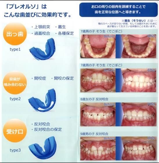 子供の歯並び気になっている方お話伺います 本格的な矯正の前にプレオルソ。お安くできます イメージ2