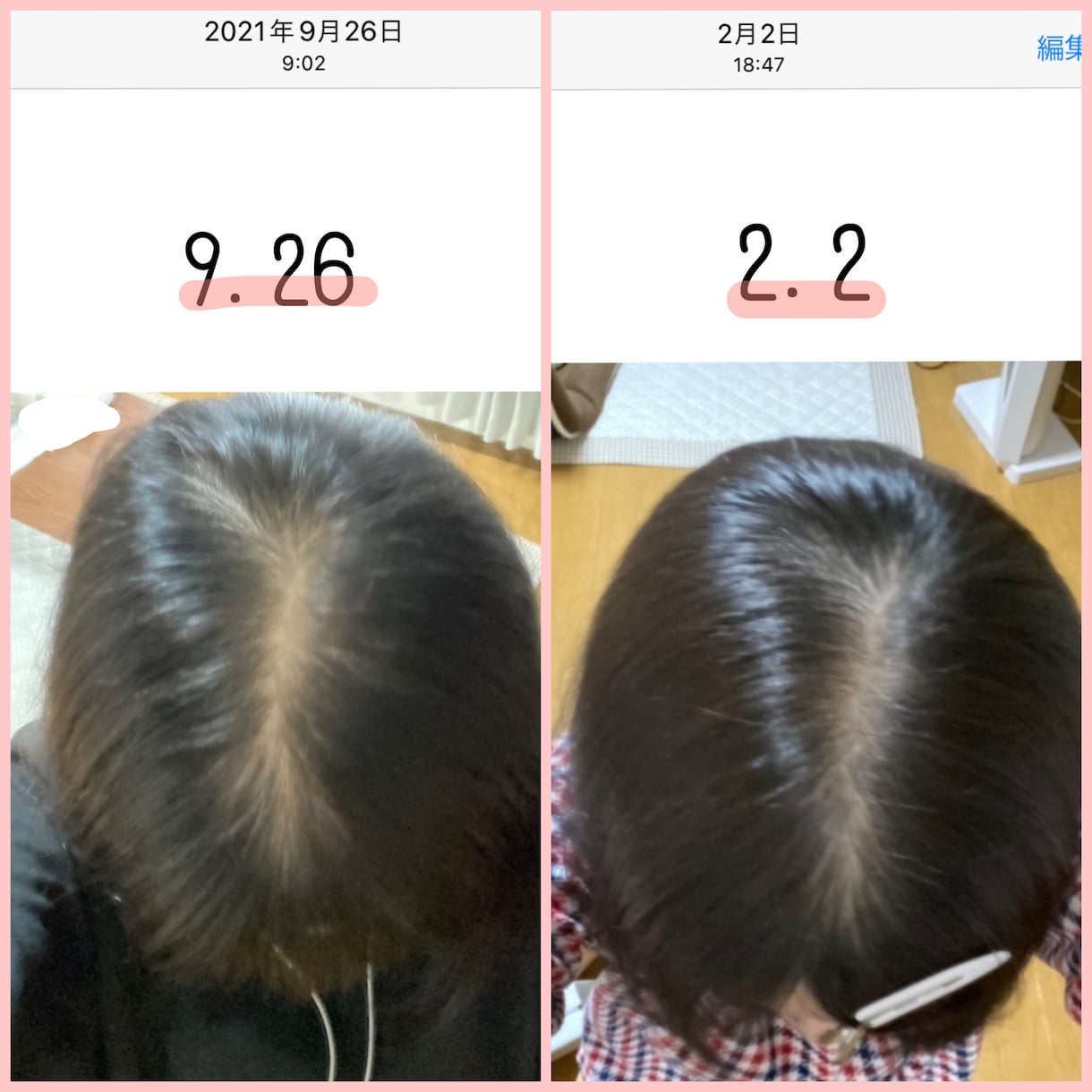 すぐできる】女性の薄毛・脱毛改善セルフケア教えます NO育毛剤、NOクリニック！月1500円で始める髪活 イメージ1