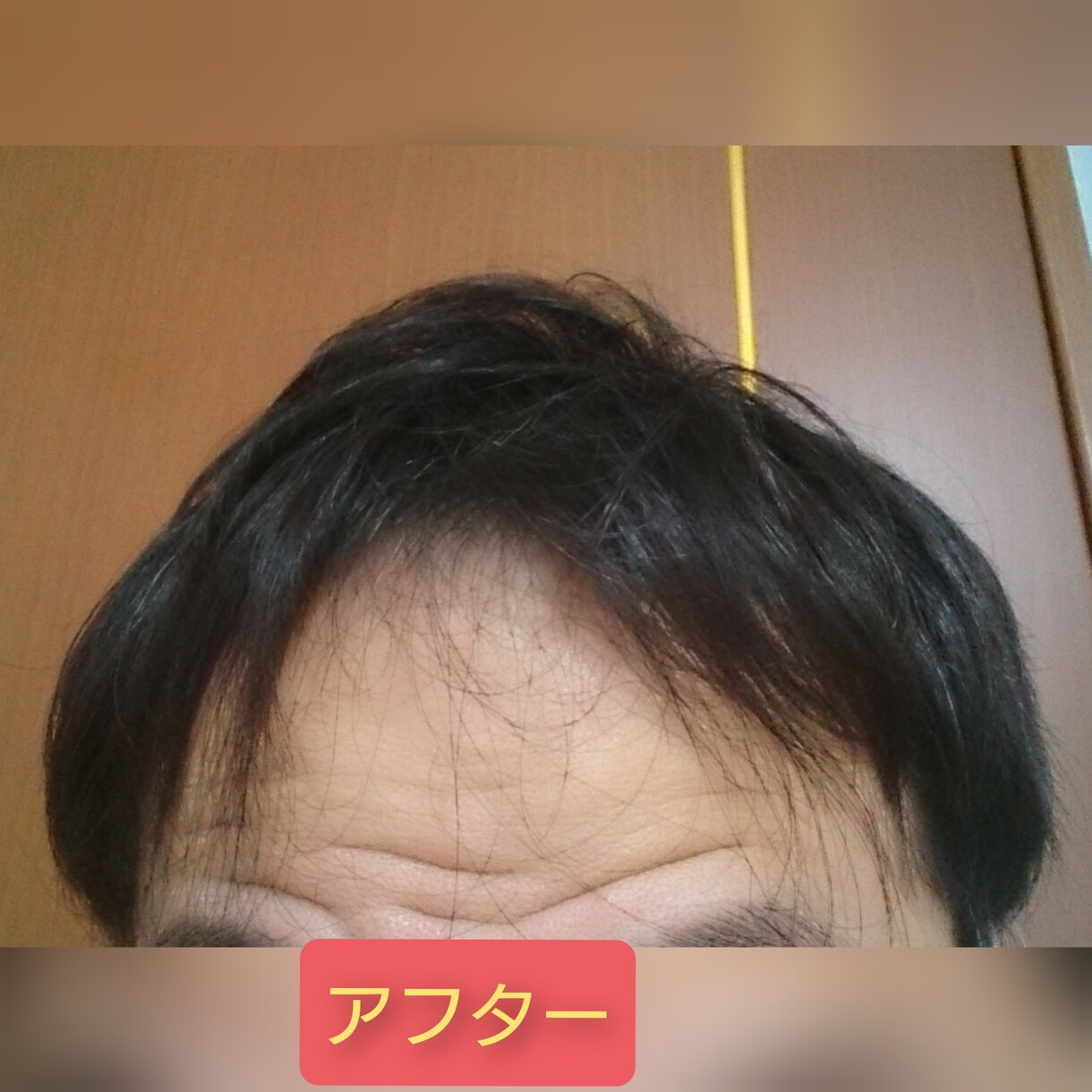 薄毛を克服した体験談を提供致します 薄毛は改善できます！私はハゲの悩みから解放されました！ イメージ3