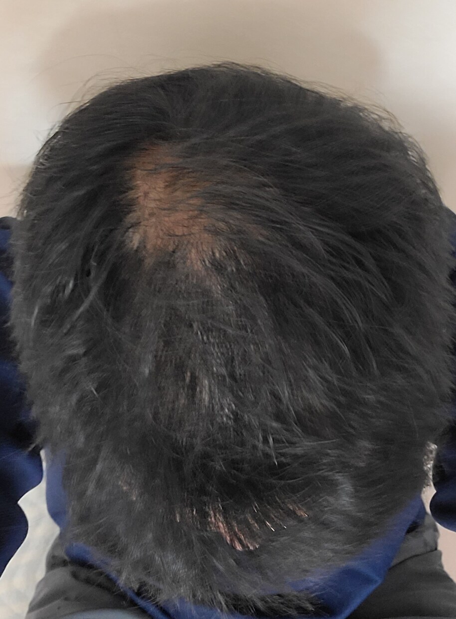 20代からの男性の薄毛の悩みの相談にのります 少しづつ薄毛を改善した、私の経験を伝えます。 イメージ2