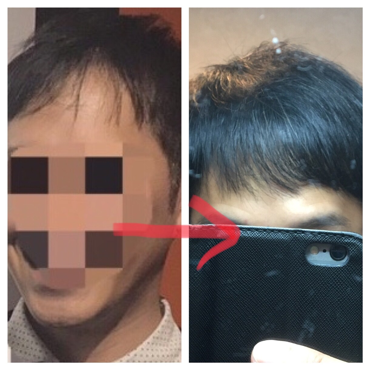 期間限定！30歳若ハゲの激安克服方法を教えます 若ハゲの悩みを持つ20代から40代の方へ イメージ1