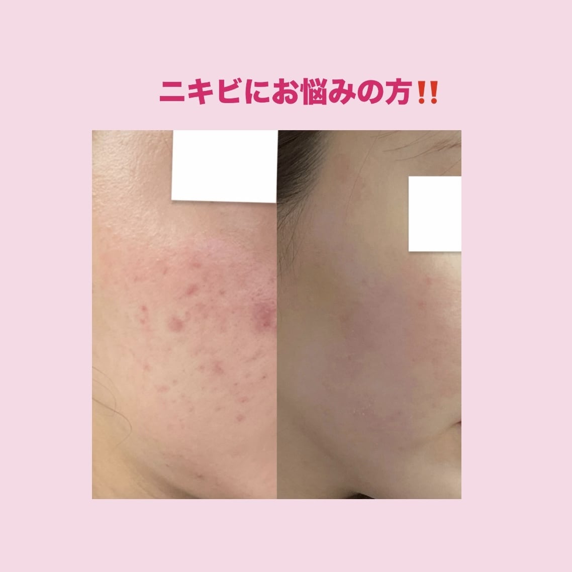 ニキビ肌を克服した私がやって良かったことを教えます 実際にやってよかったことなど、私の経験をありのまま伝えます。 イメージ1