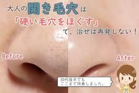いちご鼻がすっきりキレイ☆必殺技☆教えます 毛穴開き・黒ずみの解消方法⭐︎お肌診断付きです⭐︎ イメージ1