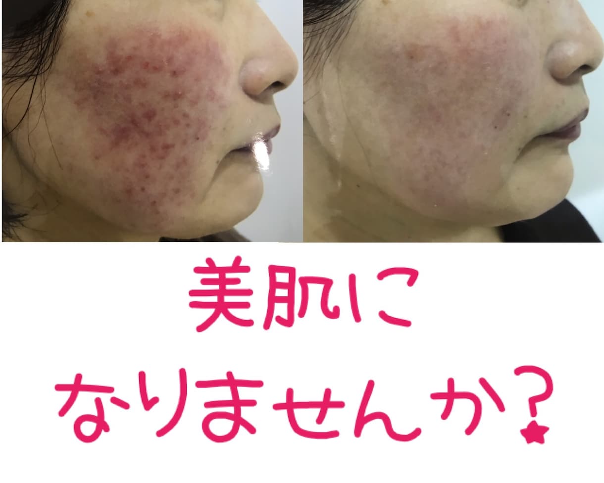 限定20名☆肌質にあったスキンケアお伝えします 500人以上の肌を肌専門サロンにてカウンセリング実績 イメージ2