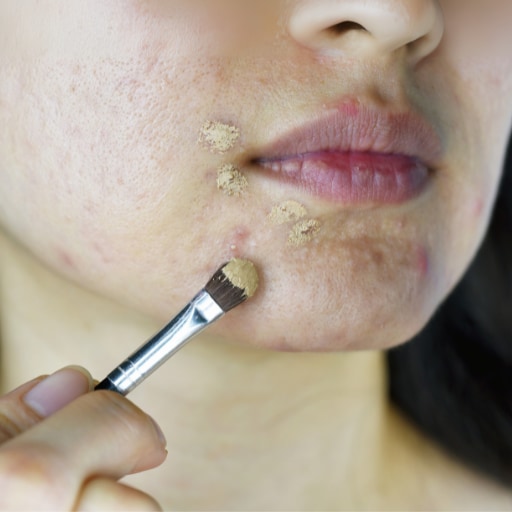 炎症ニキビを体の中から改善します 皮膚科も効かない方のための根本ケア イメージ2