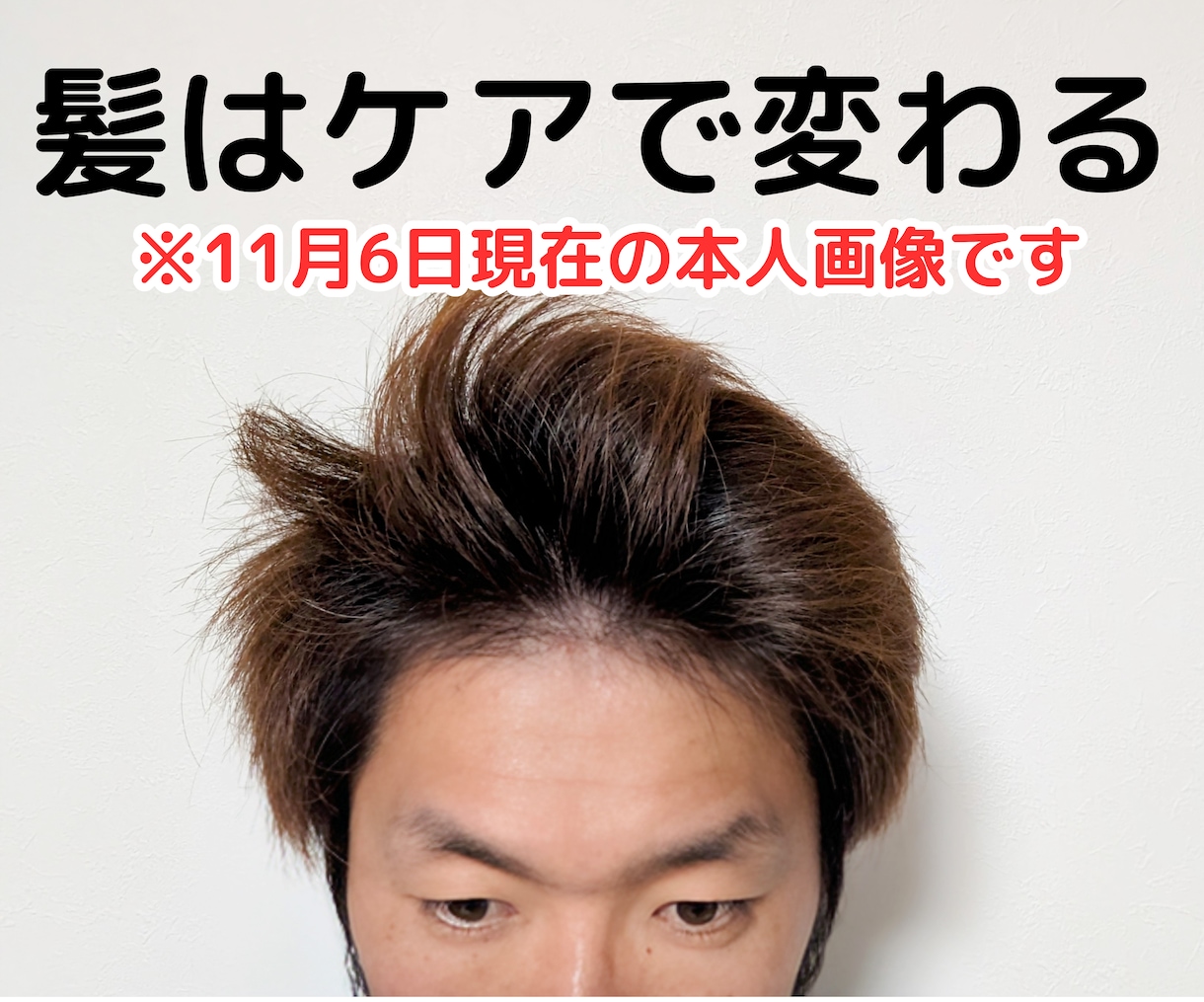 育毛歴10年の増毛達成男が頭髪の相談乗ります 【！頭髪宣言！】健やかな髪で自分らしい人生を イメージ2