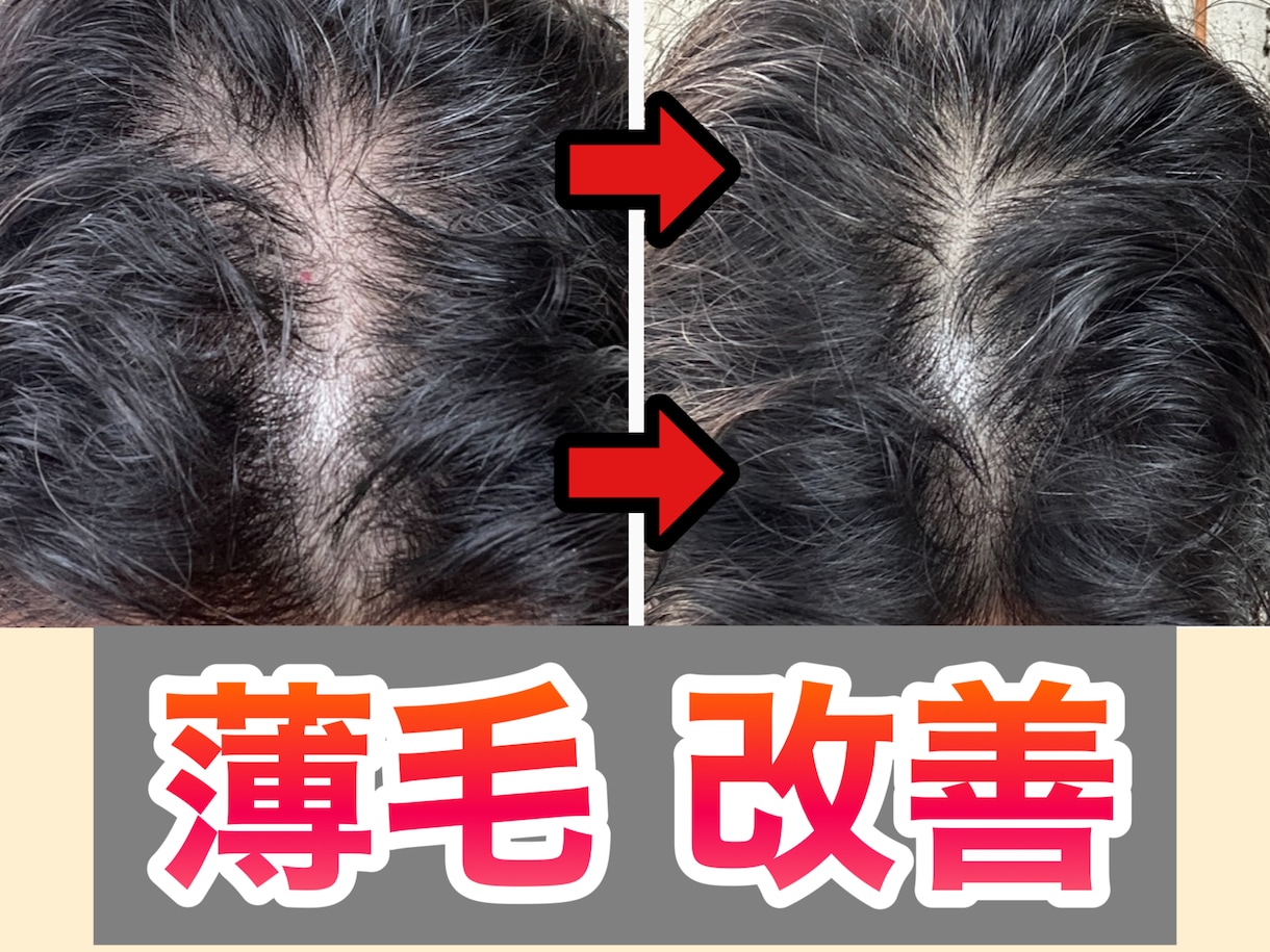 男性限定⚠️薄毛を改善させる方法をご提供いたします メンズの薄毛を徹底改善✨9割の増毛効果の実績✅ イメージ1