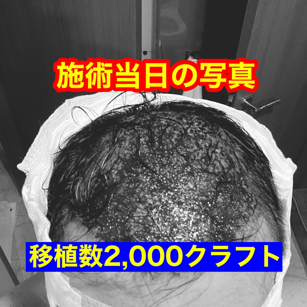植毛について、実体験に基づきアドバイスします 育毛剤、頭皮ケアはほぼ無意味！AGA治療薬は一生継続必要 イメージ1