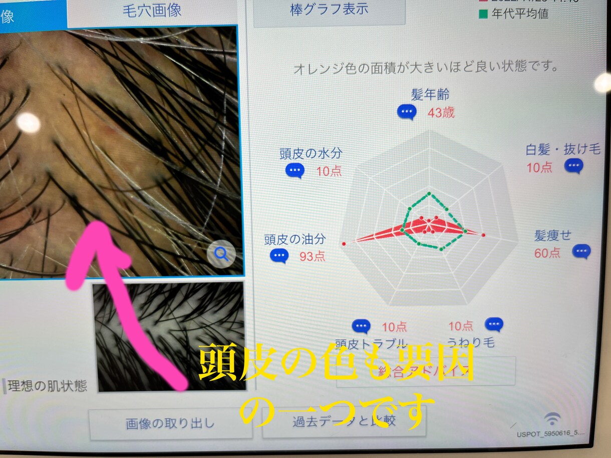 頭皮のかゆみ、フケのお悩み解消伺います 年間1000人の頭皮を診断している美容師です イメージ4