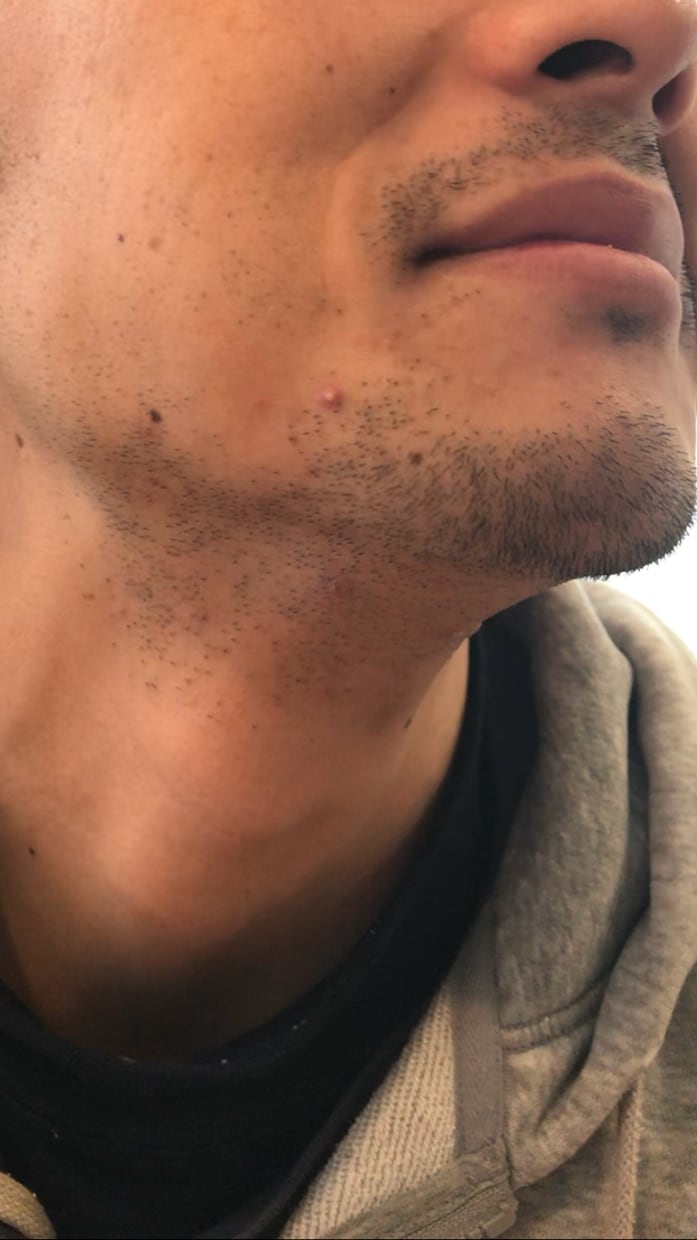 ヒゲ脱毛の経験を余すことなくお伝えします コレがヒゲ脱毛の効果！体験をお伝えします！ イメージ1