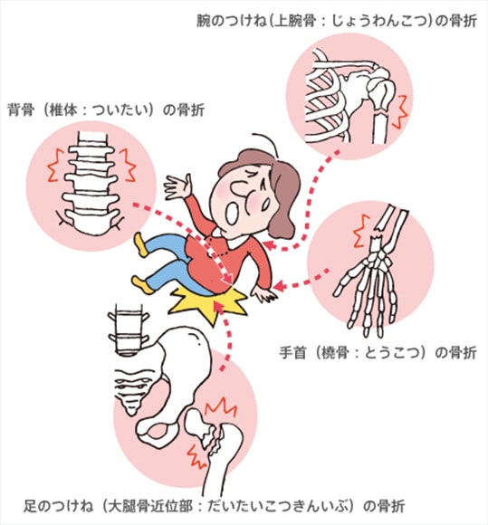 骨粗鬆症の治療薬について教えます 骨粗鬆症を多く扱う病院の薬剤師です。 イメージ1