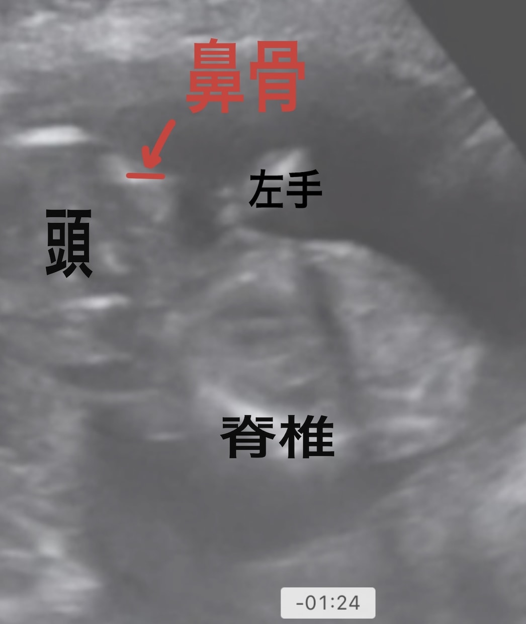 専門医がエコー全体を画像付きで解説します これはなにを見ているのかなど、胎児エコーを詳しく解説。 イメージ4