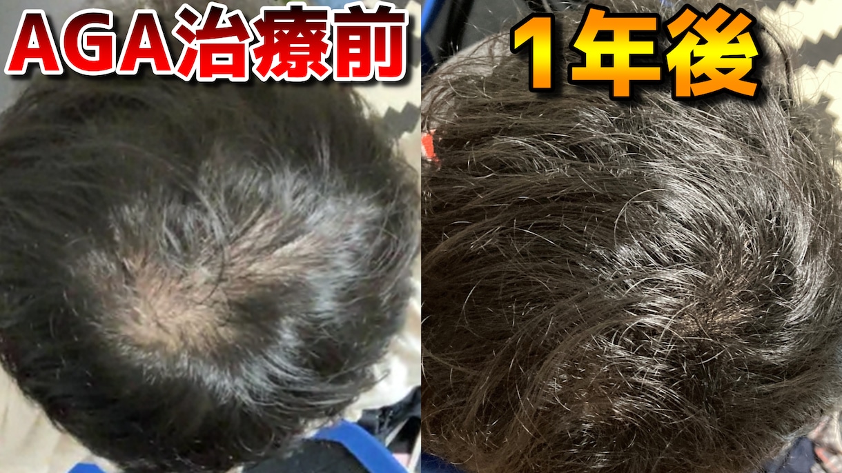AGA治療歴3年！薄毛の悩みを解決致します プロの薄毛治療ライターである私が、あなたに最適な方法をご提案 イメージ1