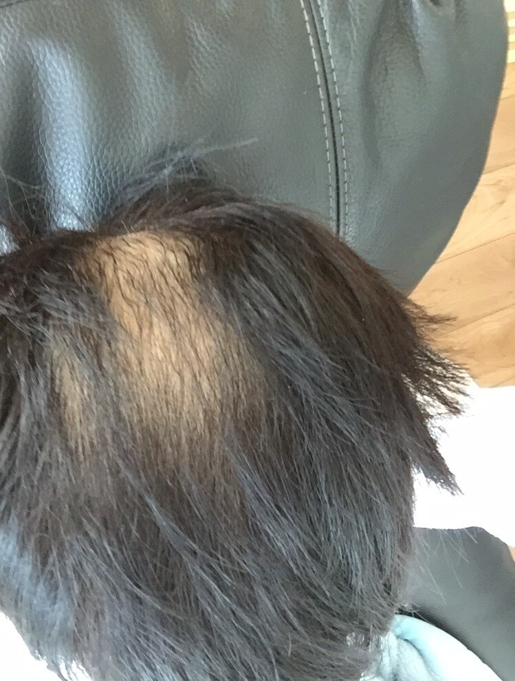 男性お悩みのAGAを経験を元に格安でお伝えします AGAやハゲで悩んでた僕の体験を元に薄毛対策を教えます。 イメージ1