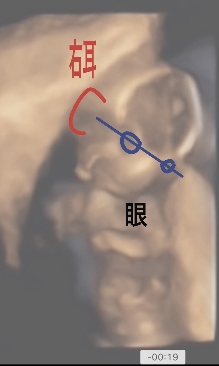 専門医がエコー全体を画像付きで解説します これはなにを見ているのかなど、胎児エコーを詳しく解説。 イメージ6