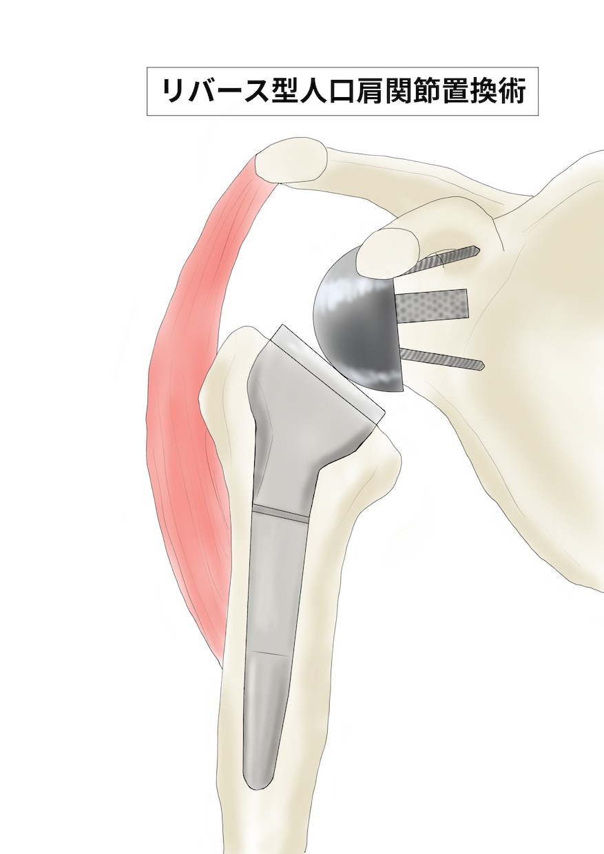 整形外科専門医が医療イラストを描きます 論文用シェーマや患者説明用イラストなどに！ イメージ6